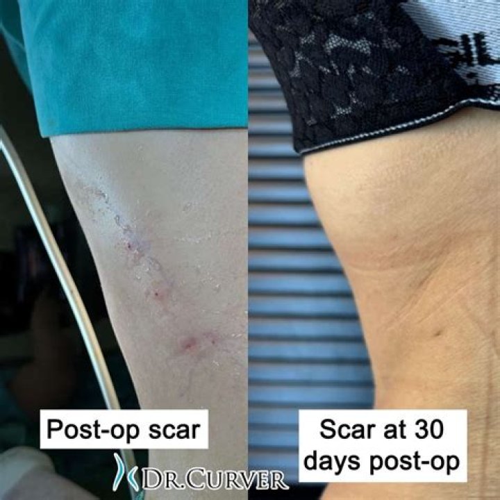 Transformative Journeys: Rib Removal Before And After