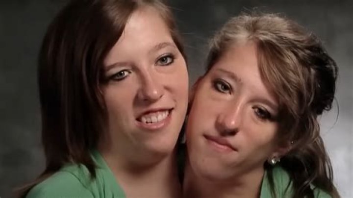 Unraveling The Heartbreaking Journey Of Conjoined Twins Abby And Brittany