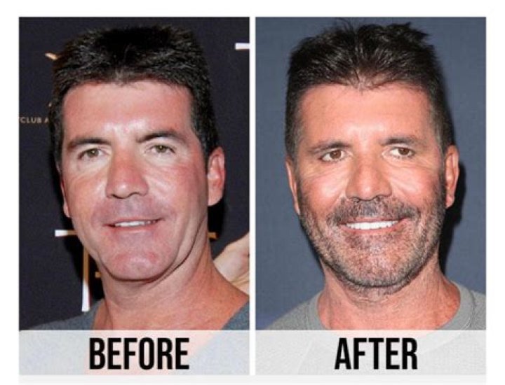 Unveiling The Mystery Behind Simon Cowell's Facelift