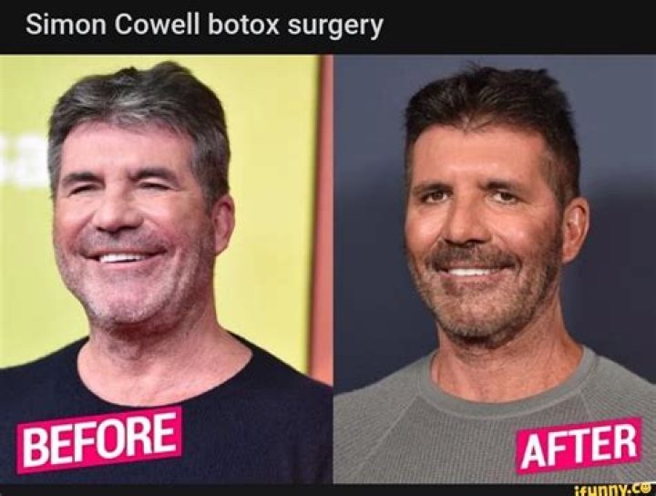 Unveiling The Truth Behind Simon Cowell's Botox Journey